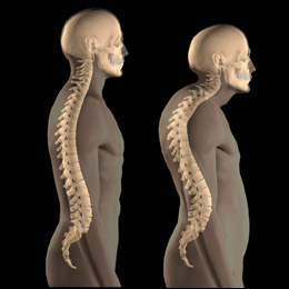 ssi benefits osteoporosis