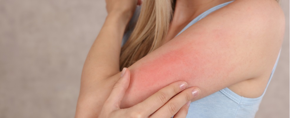 woman having rashes in his arms